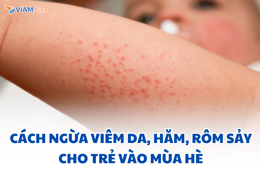 Cách ngừa viêm da, hăm, rôm sảy cho trẻ vào mùa hè VIAM clinic