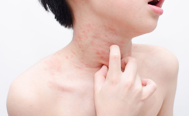 Dị ứng tôm